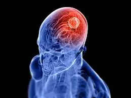  BEST BRAIN TUMOURS - in Kolkata – Dr Binod Kumar Singhania