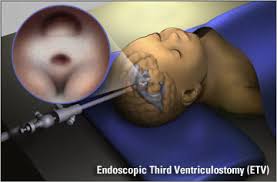 BEST ENDOSCOPIC PITUITARY & 3RD VENTRICULOSTOMY FOR HYDRO-CEPHALUS - in Kolkata – Dr Binod Kumar Singhania