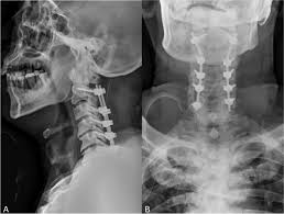 COMPLEX SPINE SURGERY INCLUDING C1-C2 TRANSPEDICULAR SCREWS - in Kolkata – Dr Binod Kumar Singhania